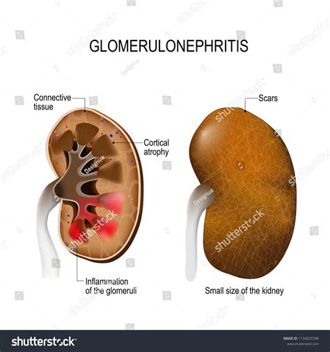 Glomerulonephritis .